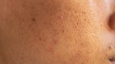 Open Pores Home Remedies:चेहरे पर दिखते हैं ओपन पोर्स या बड़े गड्ढे तो इन्हें कम करेंगी रसोई की ये 5 चीजें, जान लीजिए जबरदस्त नुस्खे..