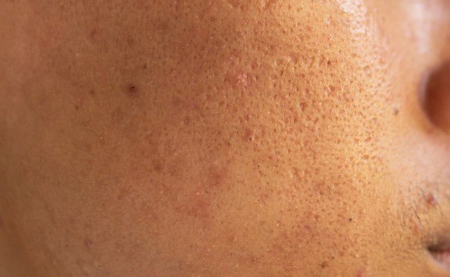 Open Pores Home Remedies:चेहरे पर दिखते हैं ओपन पोर्स या बड़े गड्ढे तो इन्हें कम करेंगी रसोई की ये 5 चीजें, जान लीजिए जबरदस्त नुस्खे..